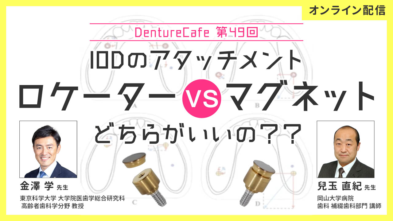 第49回「IODのアタッチメント、“ロケーターvsマグネット” どちらがいいの？？」のサムネイル