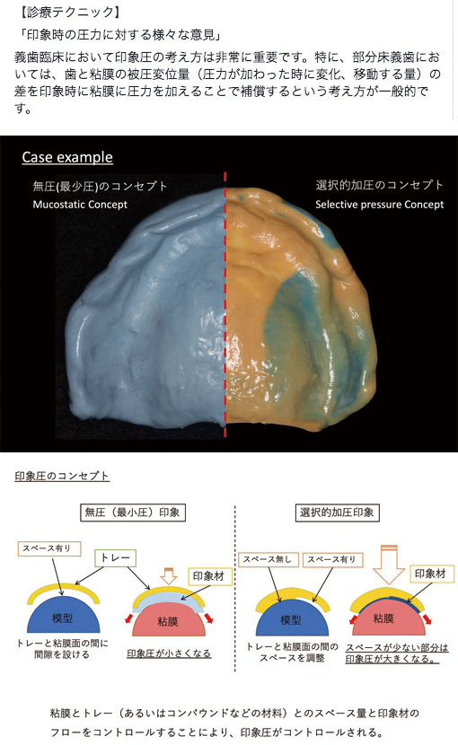 義歯補綴の基礎理論などの学術情報（詳しい図解付き）